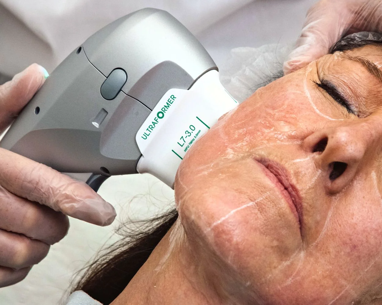 Hifu avis négatif, ce que les patientes regrettent vraiment après séance